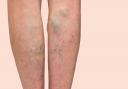 About one in four or five people are affected by varicose veins or thread veins