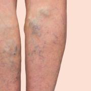 About one in four or five people are affected by varicose veins or thread veins